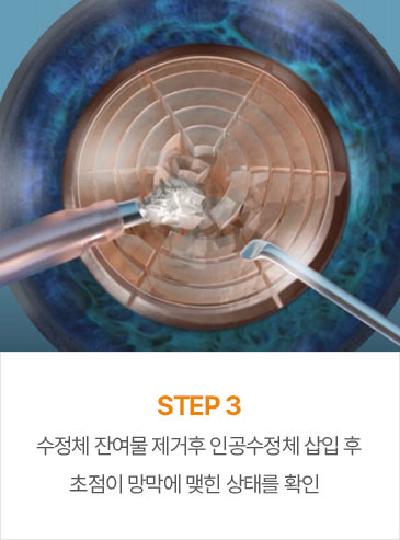 STEP3 수정체 잔여물 제거후 인공수정체 삽입 후초점이 망막에 맺힌 상태를 확인